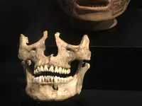 Pre-Columbian Chorotega Jaw with Filed Teeth
