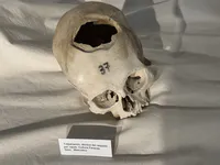 Paracas Trepanation Technique