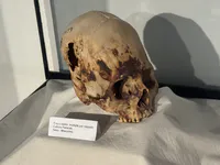 Paracas Culture Trepanation