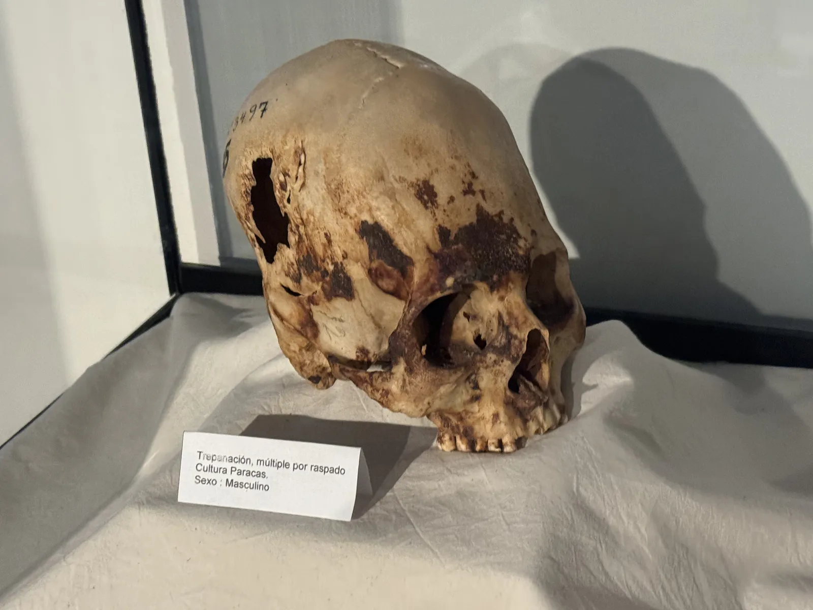 Paracas Culture Trepanation